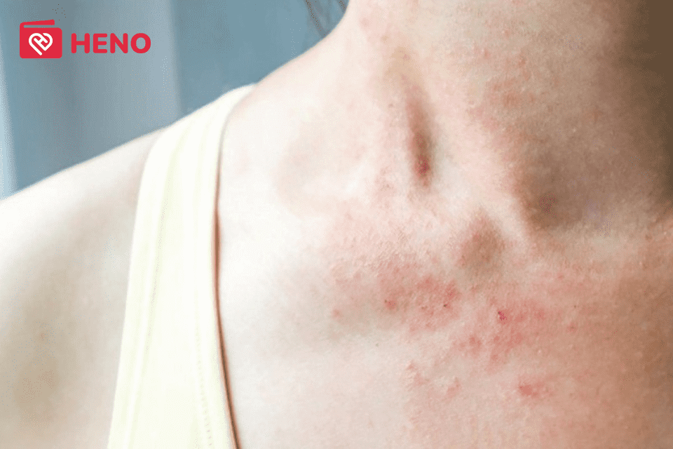 Da bị kích ứng mẩn đỏ: Nguyên nhân và cách điều trị tại nhà